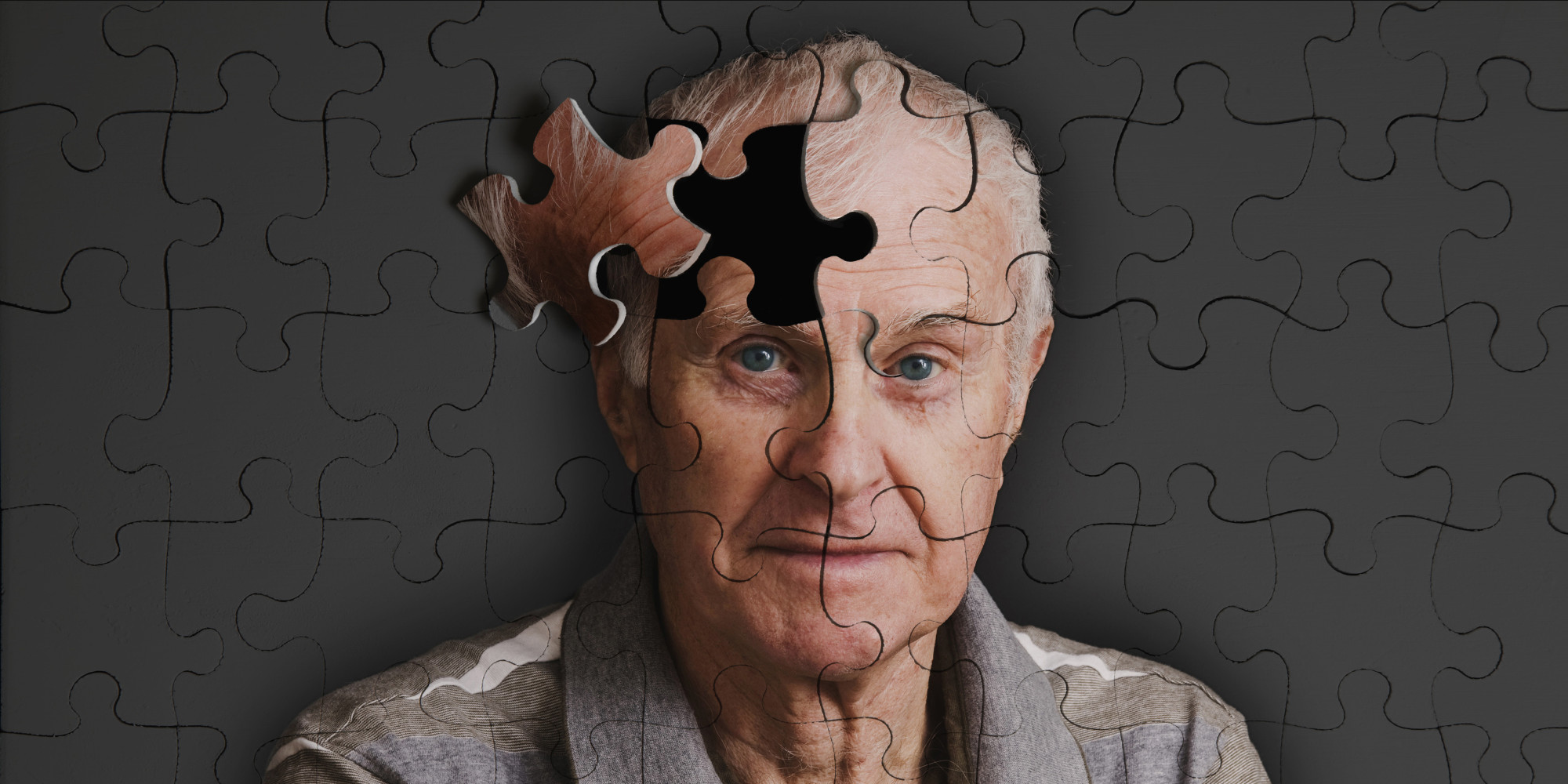Read more about the article Alzheimer